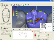 SmartDesigner CAD CAM Dental CNC Software